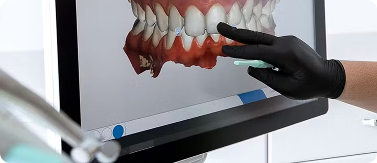 치아 준비 및 인상 채득