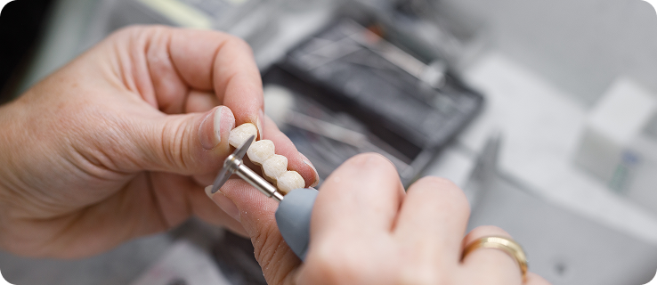 보철물 제작 및 부착