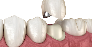 크라운 및 신경 치료