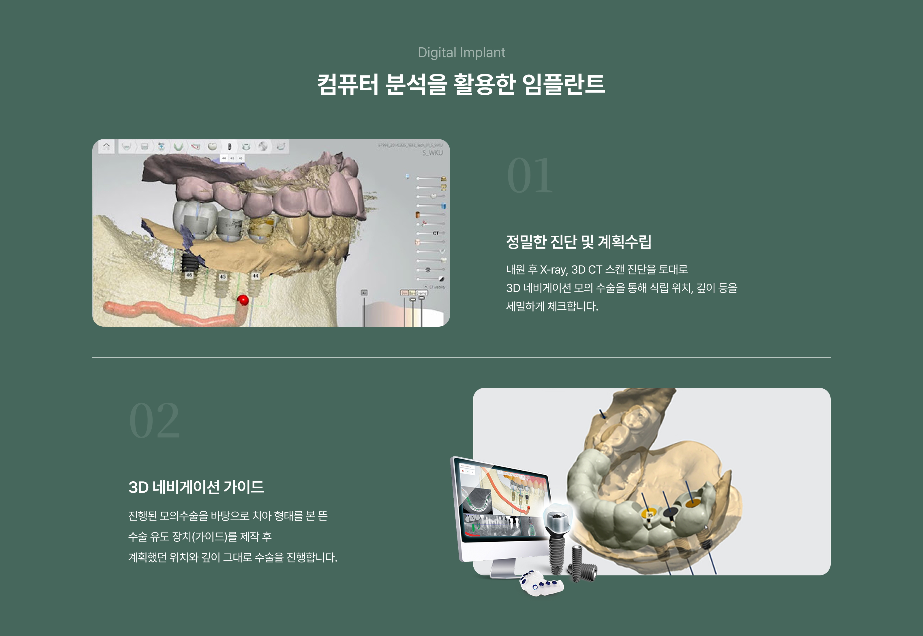 컴퓨터 분석을 활용한 임플란트