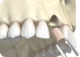 뼈 이식 수술 진행