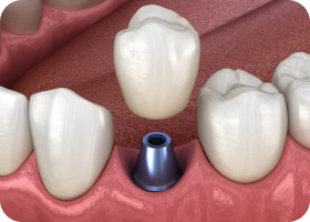보철물 제작 및 장착