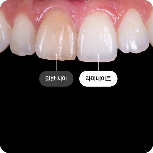 라미네이트란 무엇이며, 왜 치아 삭제가 필요한가요?